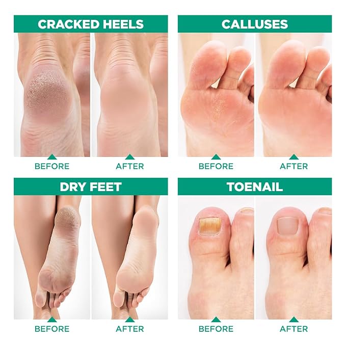 Tea Tree Oil Foot Soak with Epsom Salt - Image 6