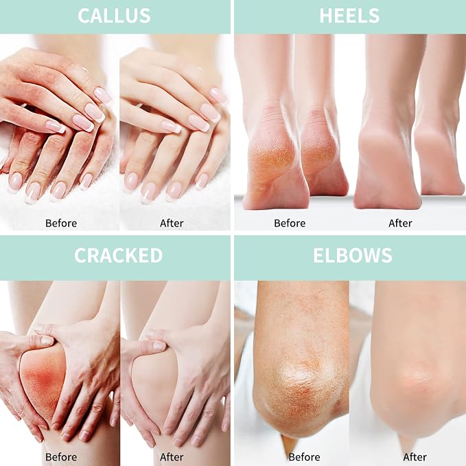 Grocerism 2 Packs Urea Cream 20% Plus 2% Salicylic Acid 5.3oz || Foot Cream - Image 4