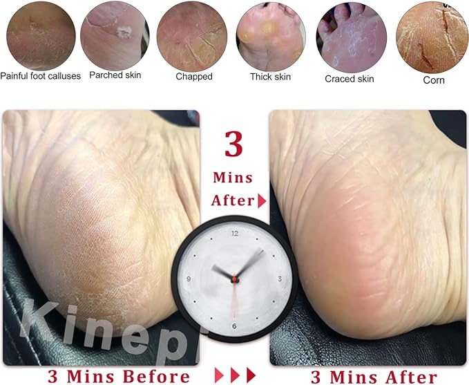 Kinepi Callus Remover Foot Scrubber Colossal Foot File Foot Care and Foot - Image 4