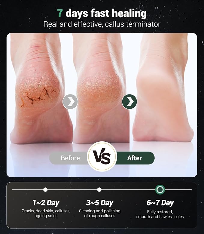 5-in-1 Professional Electric Callus Remover, Removes 99.92% of Calluses in 3 - Image 5