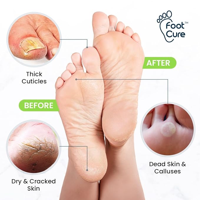 Tea Tree Foot Soak, Callus Remover Gel - Image 7