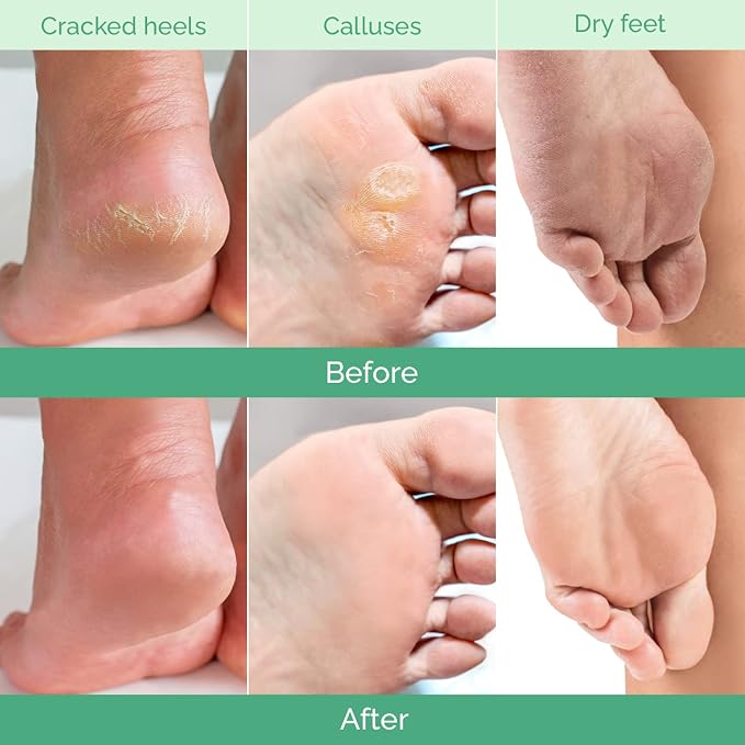 PLANTIFIQUE Foot Peeling Mask 2 Pack | Dermatologically Tested Repairs Heels & - Image 3