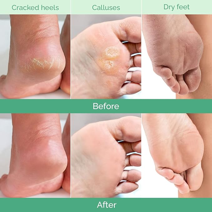 PLANTIFIQUE Foot Peeling Mask 1 Pack | Dermatologically Tested Repairs Heels & - Image 3