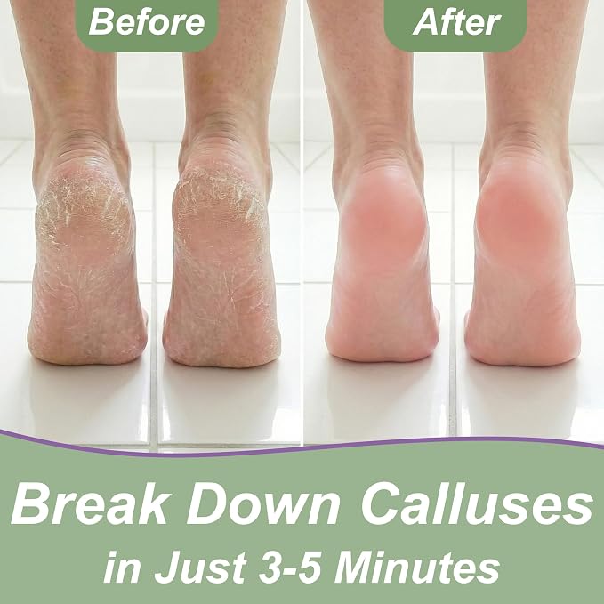 Dr. Entre's Callus Remover Gel & Foot File: Extra Strength Callus Remover - Image 4