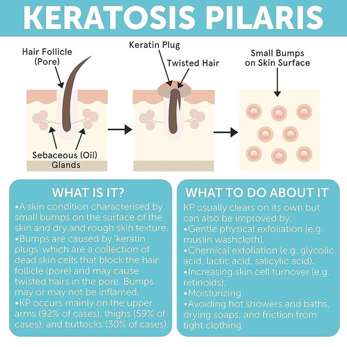 KP Bump Eraser Body Scrub with 10% AHA | Keratosis Pilaris Treatment | Bump - Image 6