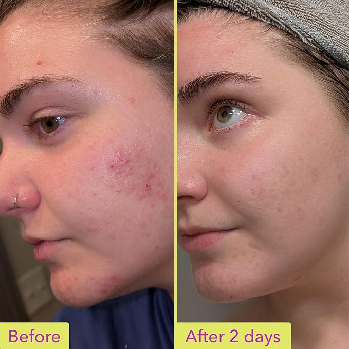 Good Molecules 10% Azelaic Acid Treatment - Image 3