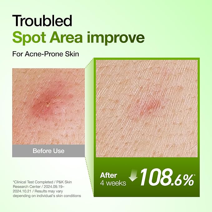 Anua Azelaic Acid 10 Hyaluron Redness Soothing Serum, Facial Serum - Image 4