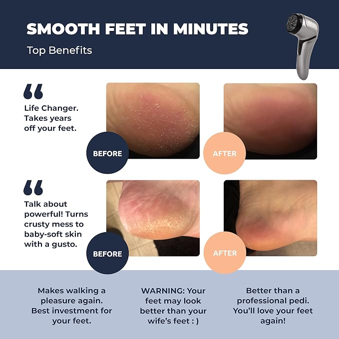 Electric Foot Callus Remover - Image 3
